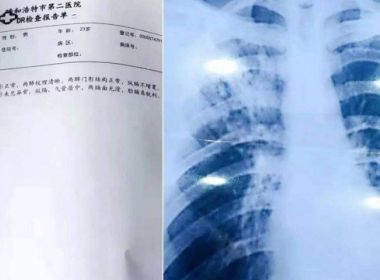 Professor da China compra diagnóstico de tuberculose por R$ 270 para prolongar feriado