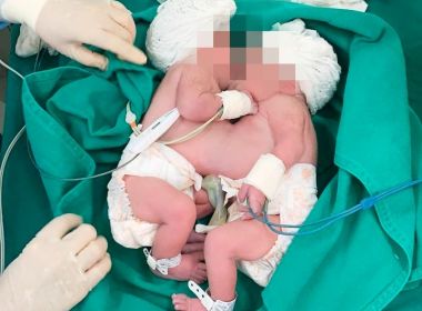 Soteropolitana dá a luz a gêmeas siamesas nesta quinta-feira
