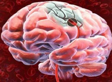 Criança tem derrame após diagnóstico de Covid-19 nos EUA; médicos pesquisam relação