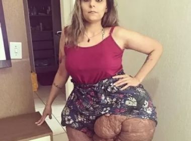 Mais de 30 kg de tumores são retirados de brasileira em cirurgia que durou 11 horas