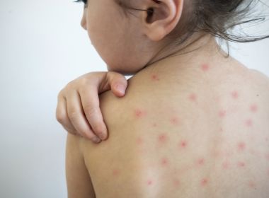 Baixa vacinação de crianças provoca aumento de casos de sarampo no Brasil