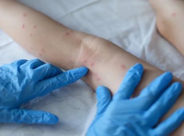 Rio de Janeiro registra primeiro caso de varíola dos macacos; homem veio de Londres