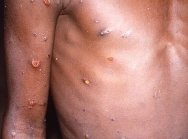 Bahia registra segundo caso de varíola dos macacos; infectado fez viagem internacional