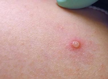 Criança diagnosticada com varíola dos macacos já está curada, afirma SMS