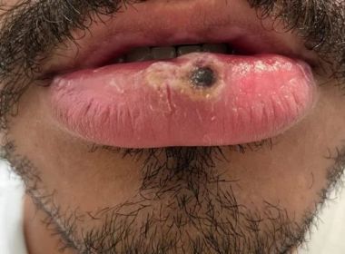 Com afta, jovem descobre monkeypox: 'Dor como cacos de vidro no lábio'
