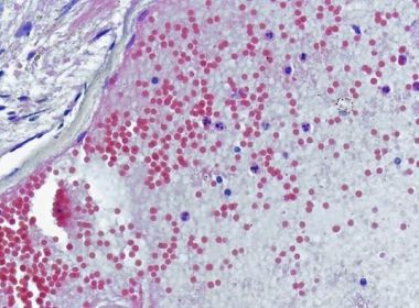 Pesquisadores encontram traços da monkeypox em pacientes sem sintomas