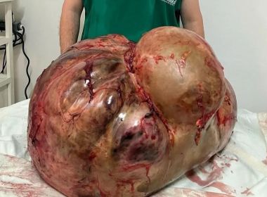 Médicos fazem cirurgia de emergência e retiram tumor de 46 kg de paciente no Rio