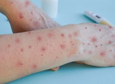 Bahia confirma novos casos da varíola dos macacos e chega a 57 infectados pela doença