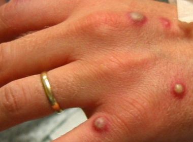 Brasil registra quinta morte decorrente da varíola dos macacos